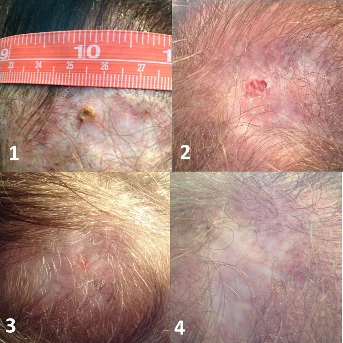 Frankincense and Skin Growths That Could Possibly Be Cancerous
