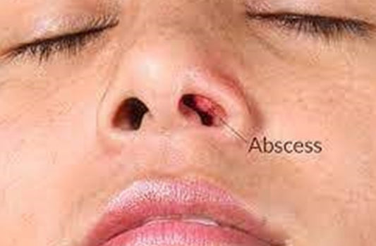 Nasal Vestibulitis: It’s Not a Pimple in Your Nose